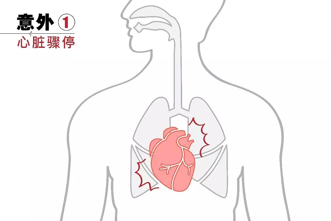 【深读】猝死离我们有多远？学会这5招，让意外不再夺走生命！（组图） - 5