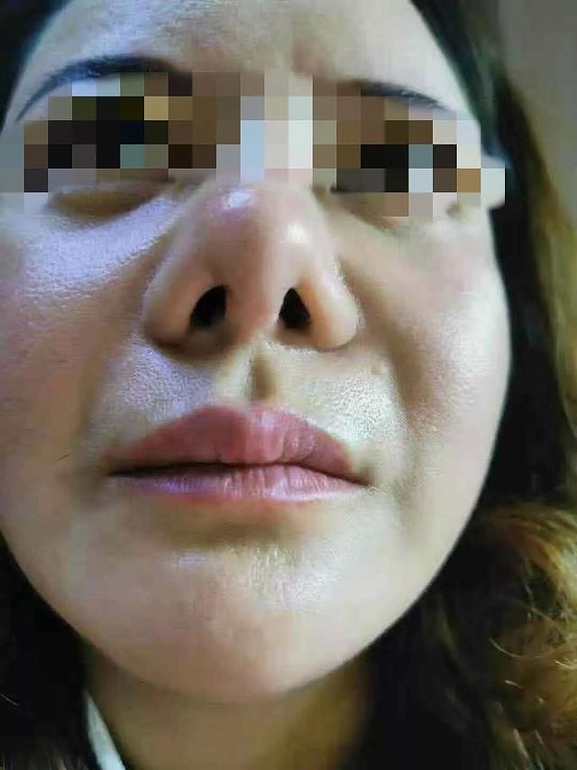 南京一女子隆鼻后变成“三毛鼻”医院：你拿遮瑕膏盖一盖