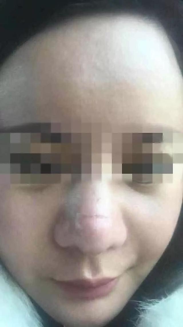 南京一女子隆鼻后变成“三毛鼻”医院：你拿遮瑕膏盖一盖