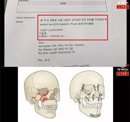 韩娱再曝暴力丑闻，51岁歌手刚订婚，就被控殴打酒店女至骨折（组图） - 6