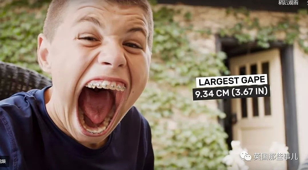 嘴大到破了世界纪录是什么画风，这14岁小男孩嘴里能塞个棒球！（组图） - 7