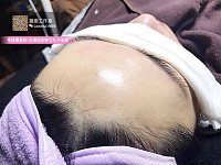  香港針清王 CHB登陸悉尼CityChatswood Facial水光瘦面