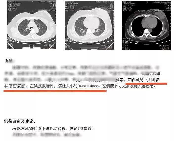 按摩、拔火罐…中国女子一年后确诊癌症晚期，崩溃痛哭：我的无知害了自己！（组图） - 2