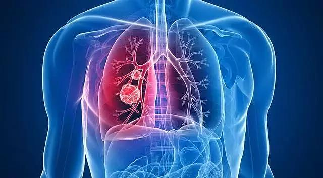 46岁阿姨不痛不痒查出肺癌，医生：手上3种标记，已到中晚期（组图） - 1