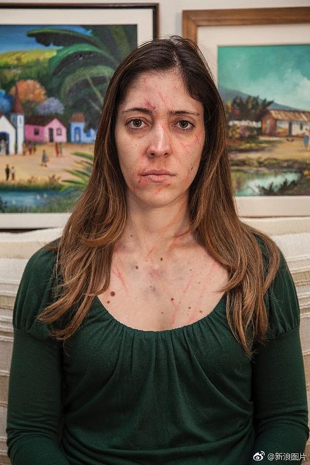 她们被丈夫用拳头击打，用刀砍，摄影师拍下被家暴的女人们