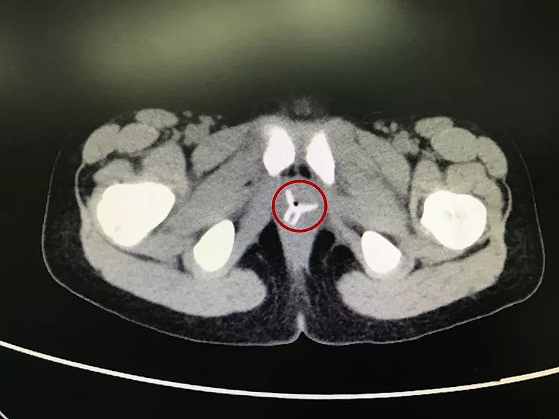 女孩肚子痛还流血，隔了几天连走路都不对劲了！医生一查吓坏了，竟是阴道里插了个…（组图） - 8