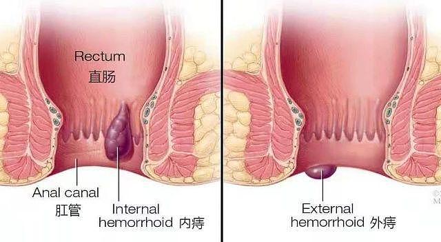 #清风计划# 做痔疮手术时放了个屁，崩了医生一脸血...