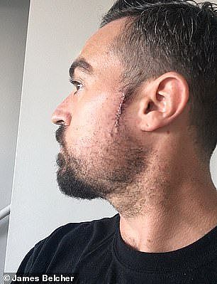 本以为小疙瘩是痘痘，结果却是恶性皮肤癌！悉尼男子去理发，结果救了自己一命！（组图） - 2