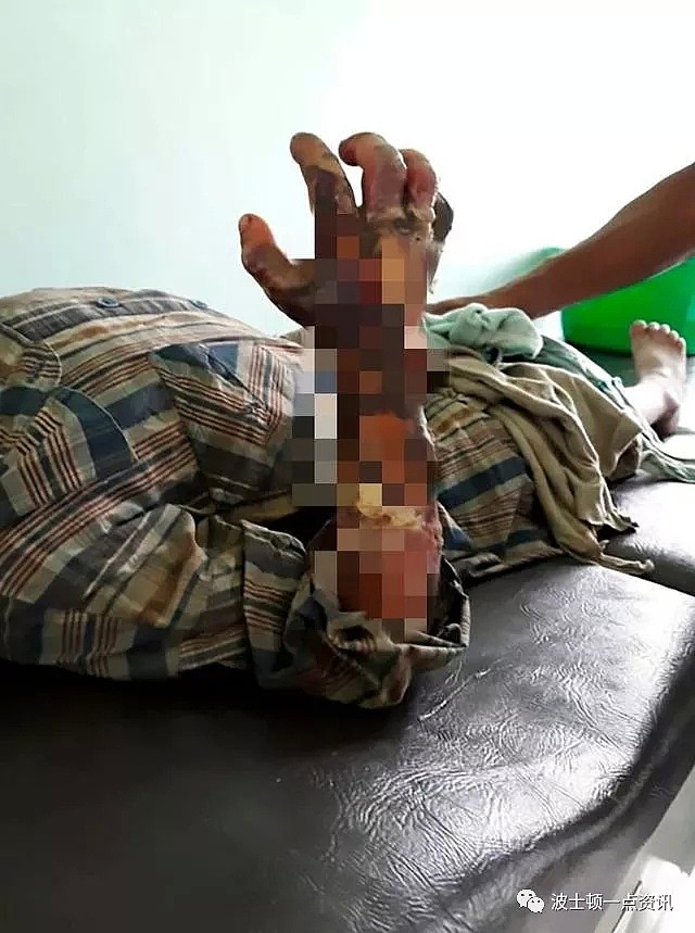 美7岁男孩太淘气，被父亲虐待、烧伤，使他失去了手臂（组图） - 1