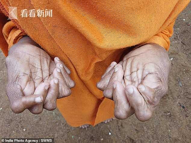 慎入！印度女子12根手指19根脚趾 破世界纪录（组图） - 3