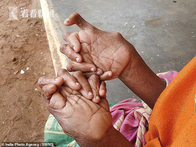 慎入！印度女子12根手指19根脚趾 破世界纪录（组图） - 7