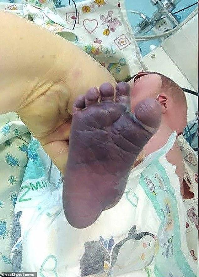 俄罗斯助产士蛮力催生，将新生儿双腿扯骨折，孩子双脚都变蓝了