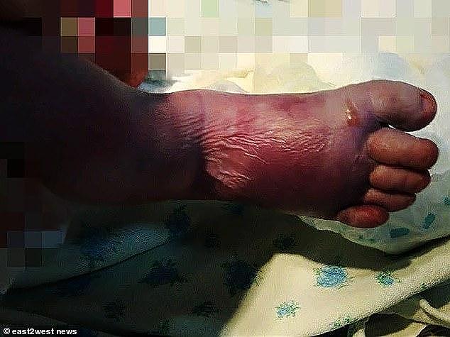 俄罗斯助产士蛮力催生，将新生儿双腿扯骨折，孩子双脚都变蓝了