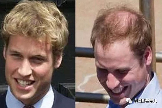 梅脱之后哈里开始积极治秃？ 但英国皇室这一窝秃顶，真能治好么?（组图） - 9