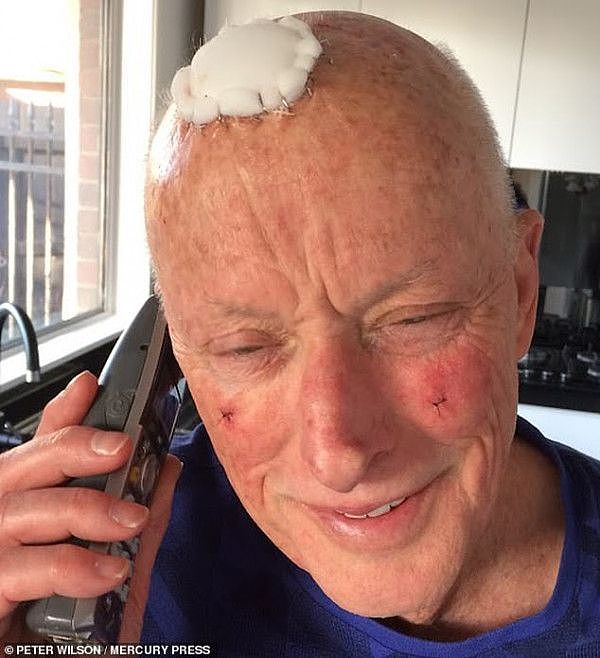 24923694-8019773-Mr_Wilson_pictured_after_surgery_with_a_dressing_on_his_scalp_an-m-21_1582105905697.jpg,0