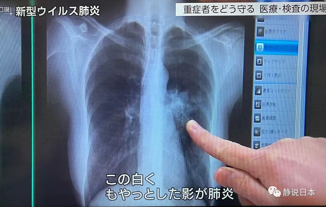 日本新冠病毒主治医生的现场观察：如何区分新冠病毒与一般感冒？（组图） - 4