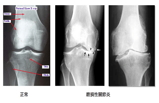 Chinese Osteoarthritis for Sydney today -Simplified3169.png,0