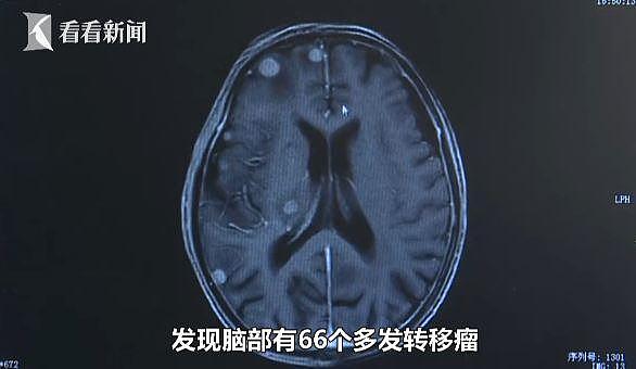 老人头晕恶心无法走路，一查发现脑中长66个肿瘤 （组图） - 2