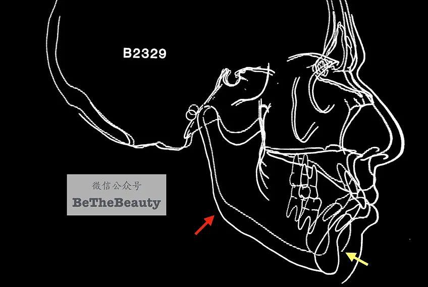 【美容】天仙也怕发腮：它是20＋最大颜值杀手吗？如何预防缓解？（组图） - 42