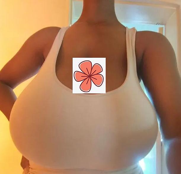 南非23岁女子胸部重达5.8斤，大小像西瓜，遭男子随意触碰