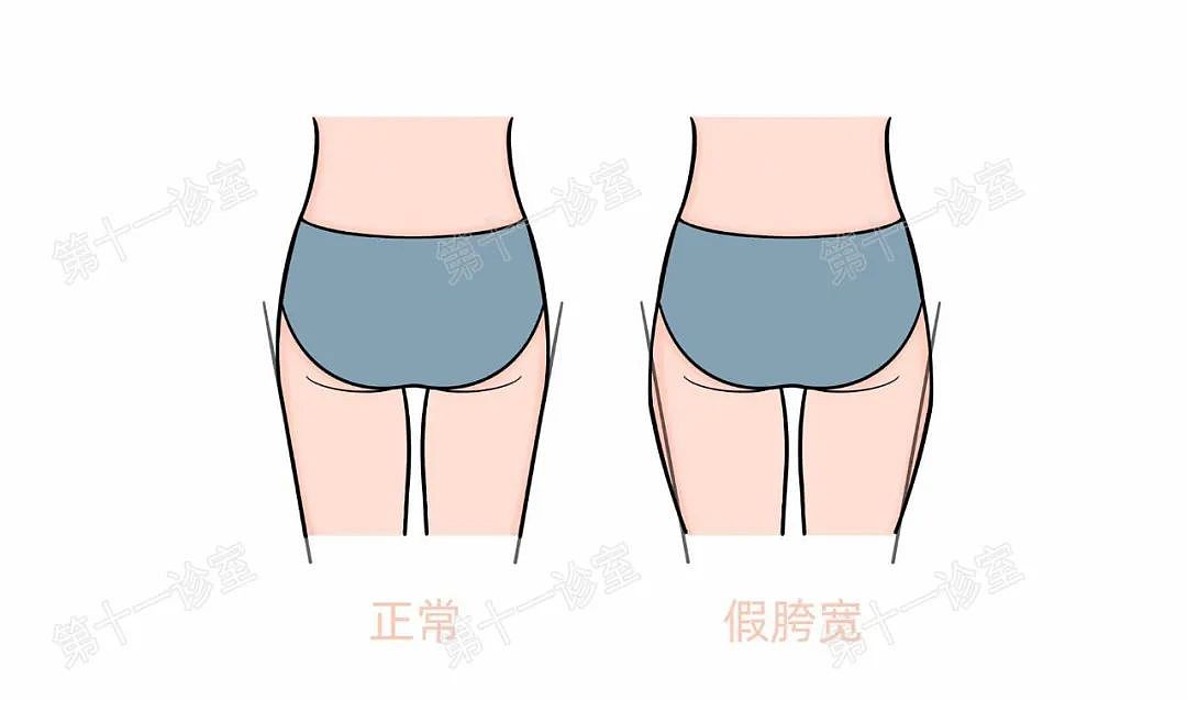 【女性】大部分姑娘都有的这个体态问题，2招教你搞定（组图） - 6