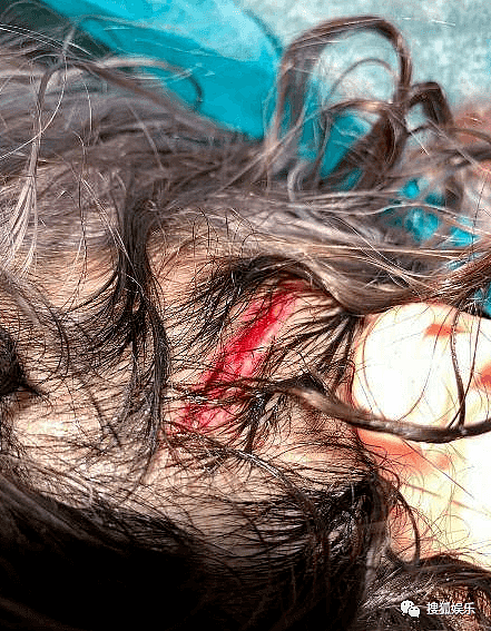 萧亚轩公开受伤照，去年拍MV意外受伤，头部受重创伤口超过5cm（组图） - 2