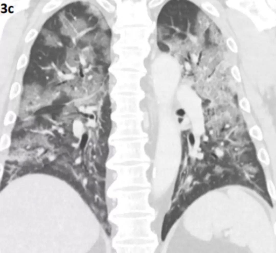 新加坡首次公布新冠肺炎患者CT，肺阴影如“碎石路”（组图） - 2