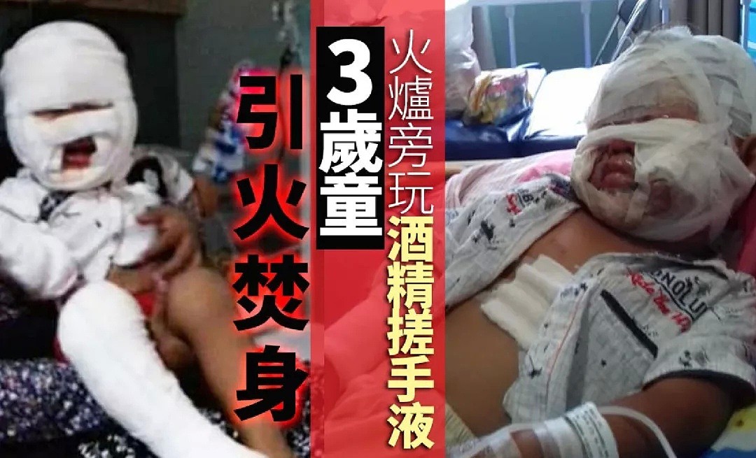 澳媒：脚上起痘恐是新冠无症状感染早期预警！2名华人女子肺部CT毛玻璃状，竟是用了它，赶紧自查 - 37