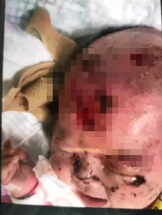 头部见骨、指关节缺失、血迹斑斑…三月龄女婴在家遭遇飞来横祸！许多医院都不敢收治（组图） - 2
