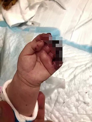 头部见骨、指关节缺失、血迹斑斑…三月龄女婴在家遭遇飞来横祸！许多医院都不敢收治（组图） - 6