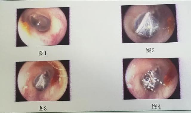 毛骨悚然！女子突然耳鸣刺痛，医生一看惊了