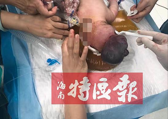 罕见！海南一新生男婴头顶多长了一个“头”！或因妈妈孕期这一举动！