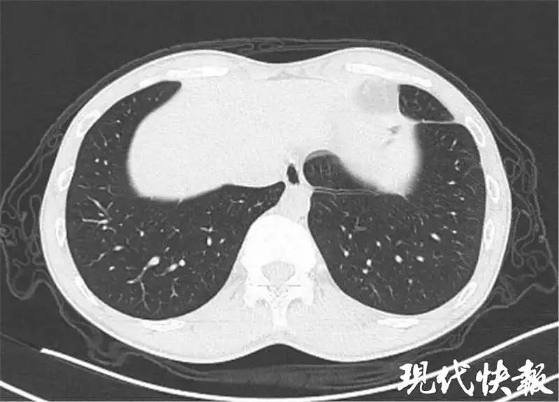 小伙胸闷、咳嗽，肺部还被钻出一个个 “隧道”！元凶竟是…