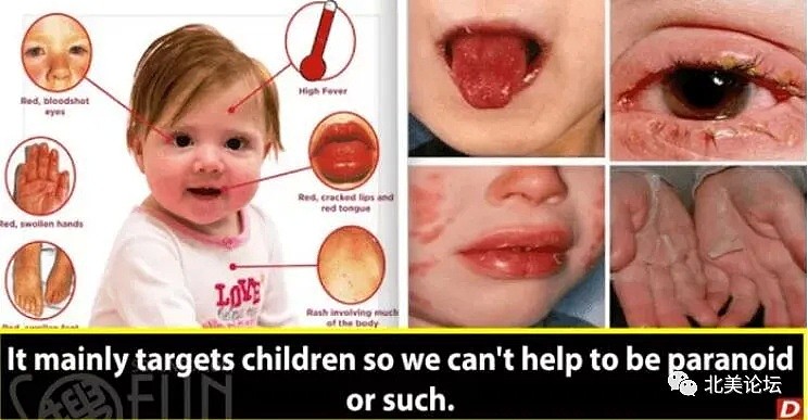 美国确诊123万！华人区8岁儿童突发怪病，抽搐嘴唇紫色，一查新冠阳性，已有15名儿童中招（组图） - 15