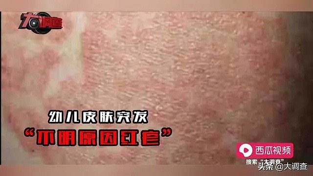 中国再现“大头娃娃”事件 诱因成谜 官方称奶粉系合格产品（组图） - 3