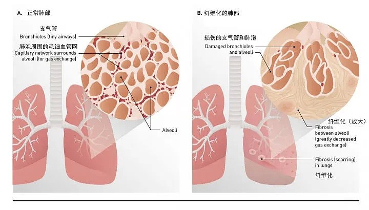 欧美出现新情况！“新冠后遗症”大量涌现，多器官受损，终于，一个残忍的真相被揭开 - 6