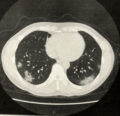 日本一33岁男子确诊新冠肺炎26天后，他决定公开自己患病历程（组图） - 4