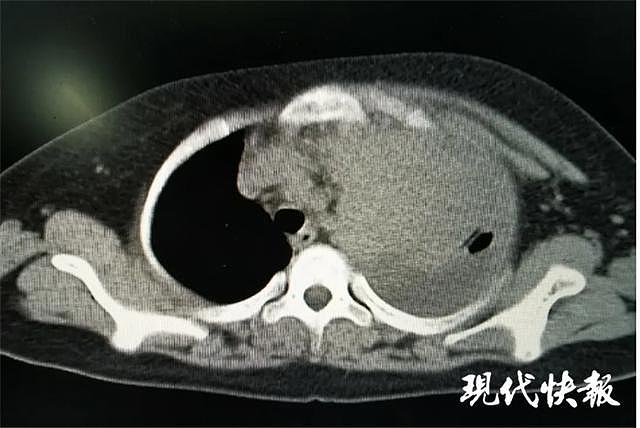 11岁男孩左肺离奇“消失”，医生惋惜：是罕见恶性肿瘤，晚期