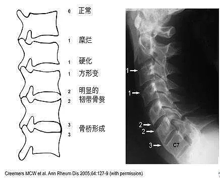 女儿刚满18岁就要受这种折磨！浙江一家4口患上“不死的癌症”，这种痛千万别忽视（组图） - 3