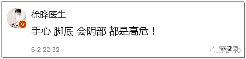 全网热议！赶紧看看你脚底和手上有无黑痣，可能会要命！（组图） - 5