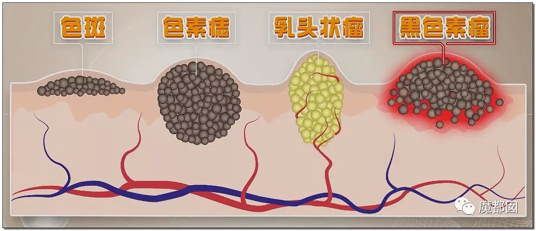 全网热议！赶紧看看你脚底和手上有无黑痣，可能会要命！（组图） - 41