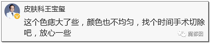 全网热议！赶紧看看你脚底和手上有无黑痣，可能会要命！（组图） - 63