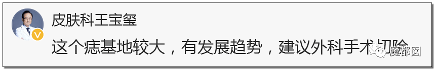 全网热议！赶紧看看你脚底和手上有无黑痣，可能会要命！（组图） - 65