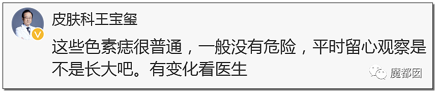 全网热议！赶紧看看你脚底和手上有无黑痣，可能会要命！（组图） - 69