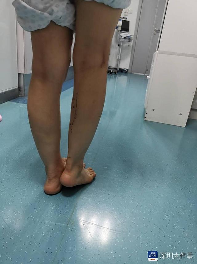 深圳女子爱美花费万元打瘦腿针，数月后双腿长短不一，走路跛行