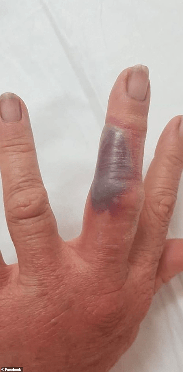 痛！北领地女自手指被咬伤，肿胀瘀黑惨不忍睹，这种毒物遍布澳洲（视频/组图） - 2