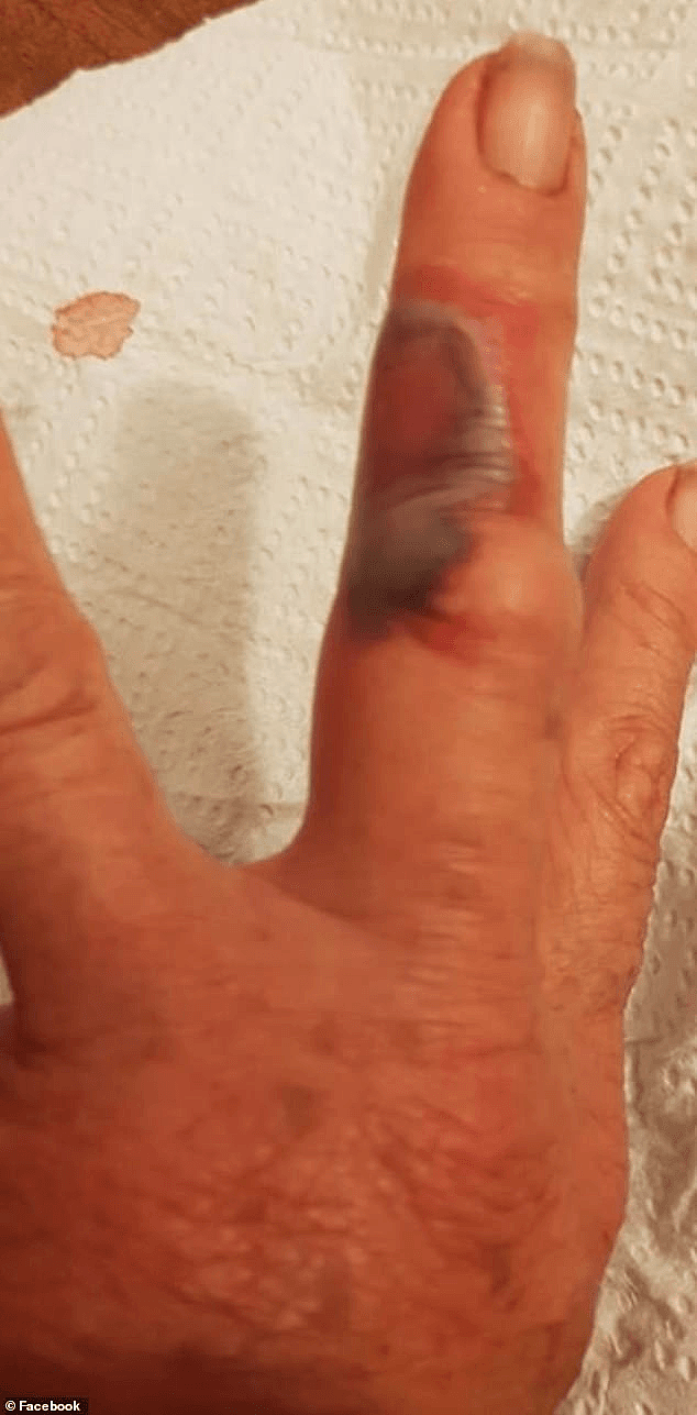 痛！北领地女自手指被咬伤，肿胀瘀黑惨不忍睹，这种毒物遍布澳洲（视频/组图） - 3