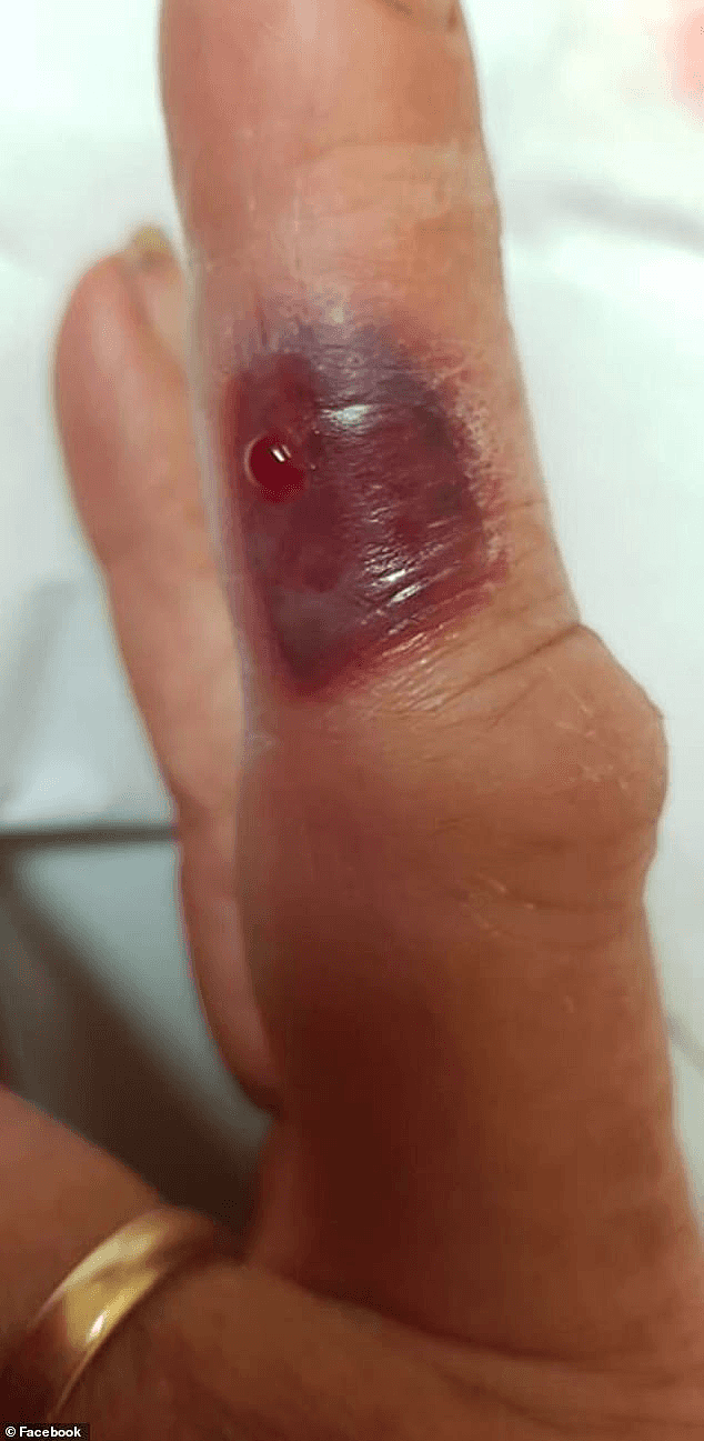 痛！北领地女自手指被咬伤，肿胀瘀黑惨不忍睹，这种毒物遍布澳洲（视频/组图） - 4