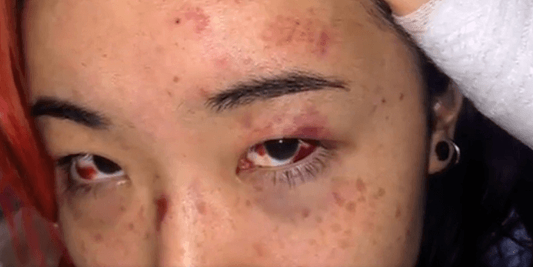 受伤照流出，被暴打后UBC华人女留学接受采访：“喊救命没人理”！（视频/组图） - 14
