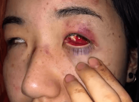 受伤照流出，被暴打后UBC华人女留学接受采访：“喊救命没人理”！（视频/组图） - 16